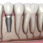 What Makes Dental Implants So Popular?