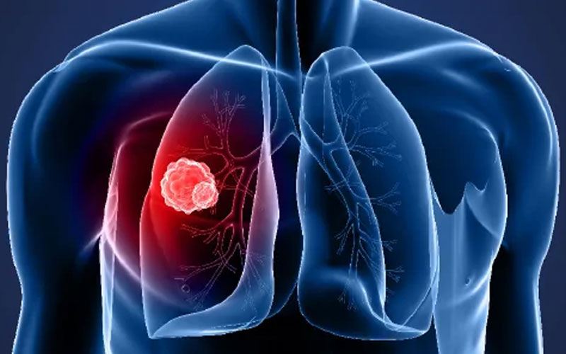 Lung Cancer Can Have Mild Connected Symptoms