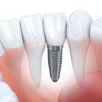 Reasons You Should Get Dental Implants?