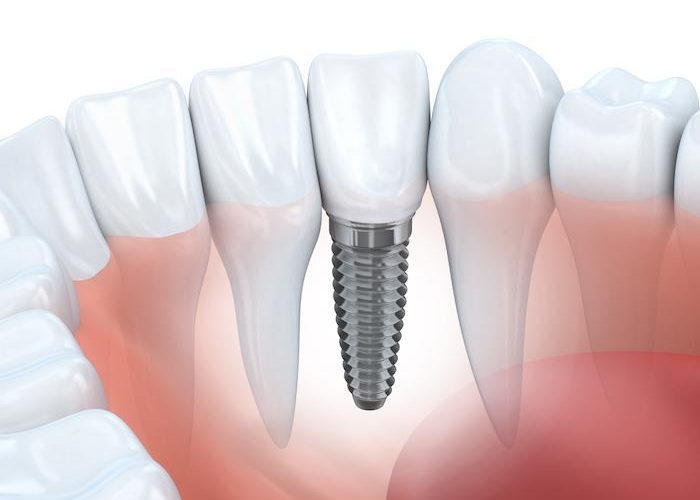 Reasons You Should Get Dental Implants?