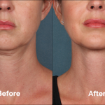 Who Is An Excellent Candidate For Kybella Treatments?