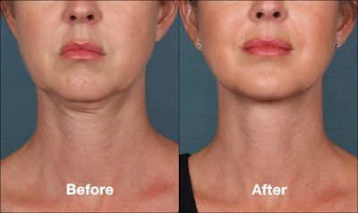 Who Is An Excellent Candidate For Kybella Treatments?