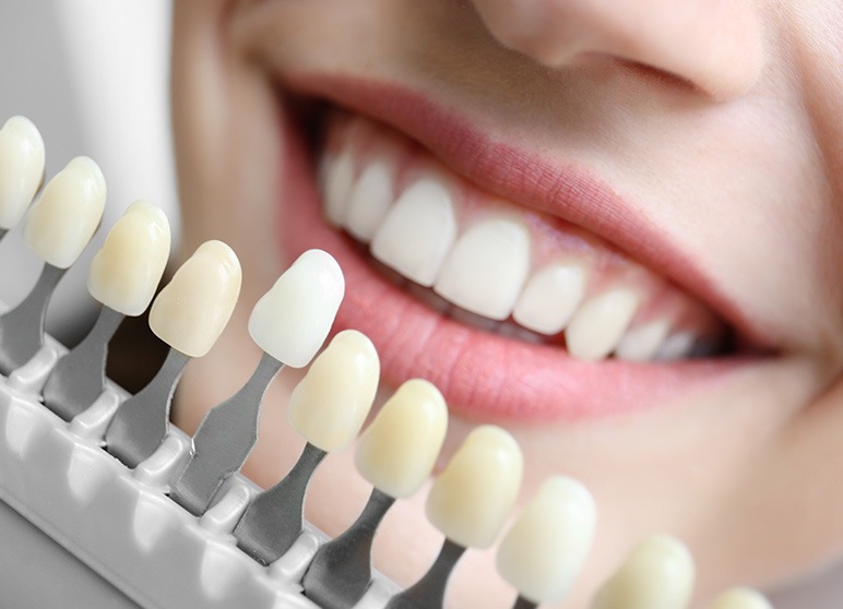 Facts about Veneers That You Do Not Know
