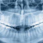 Why Should You Opt For Dental X-rays