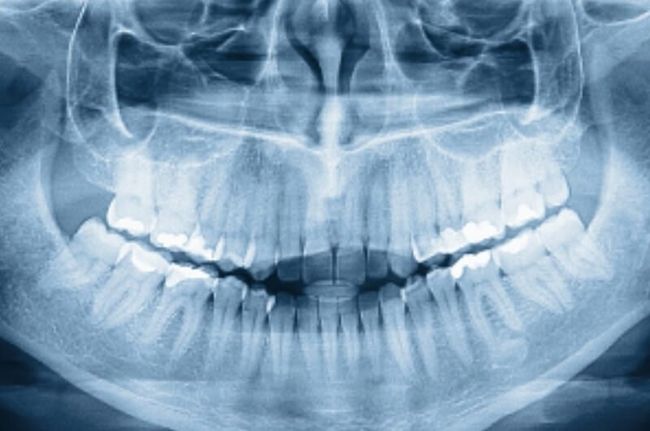 Why Should You Opt For Dental X-rays