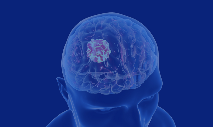 Risk Factors, Diagnosis, and Treatment for Brain Tumors