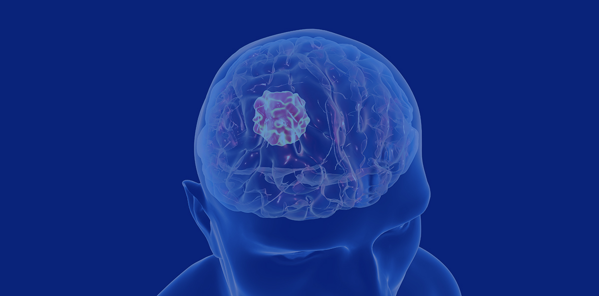 Risk Factors, Diagnosis, and Treatment for Brain Tumors
