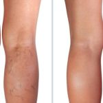 When to Seek Medical Help for Spider Veins?