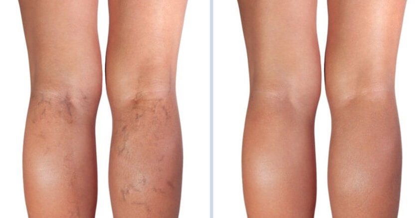 When to Seek Medical Help for Spider Veins?