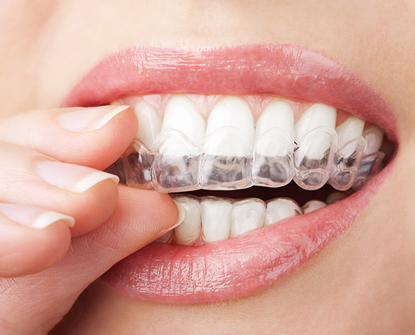 Myths and Misconceptions about Invisalign