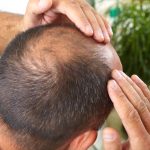 What You Might Not Know About Hair Transplant