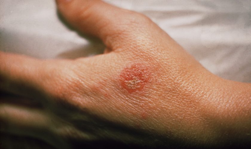 7 Facts Concerning Eczema That You Should Understand