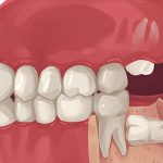Everything You Should Know About Wisdom Teeth