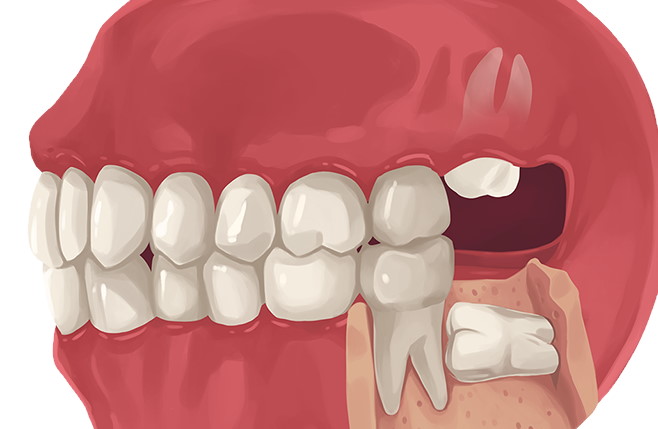 Everything You Should Know About Wisdom Teeth