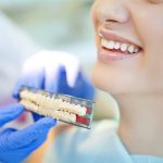 How Important Are Dental Bridges to Oral Health?
