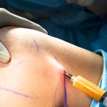 What to Expect From a Fat Transfer Procedure