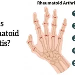 Arthritis Explained