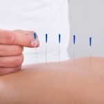 5 Amazing Benefits of Acupuncture