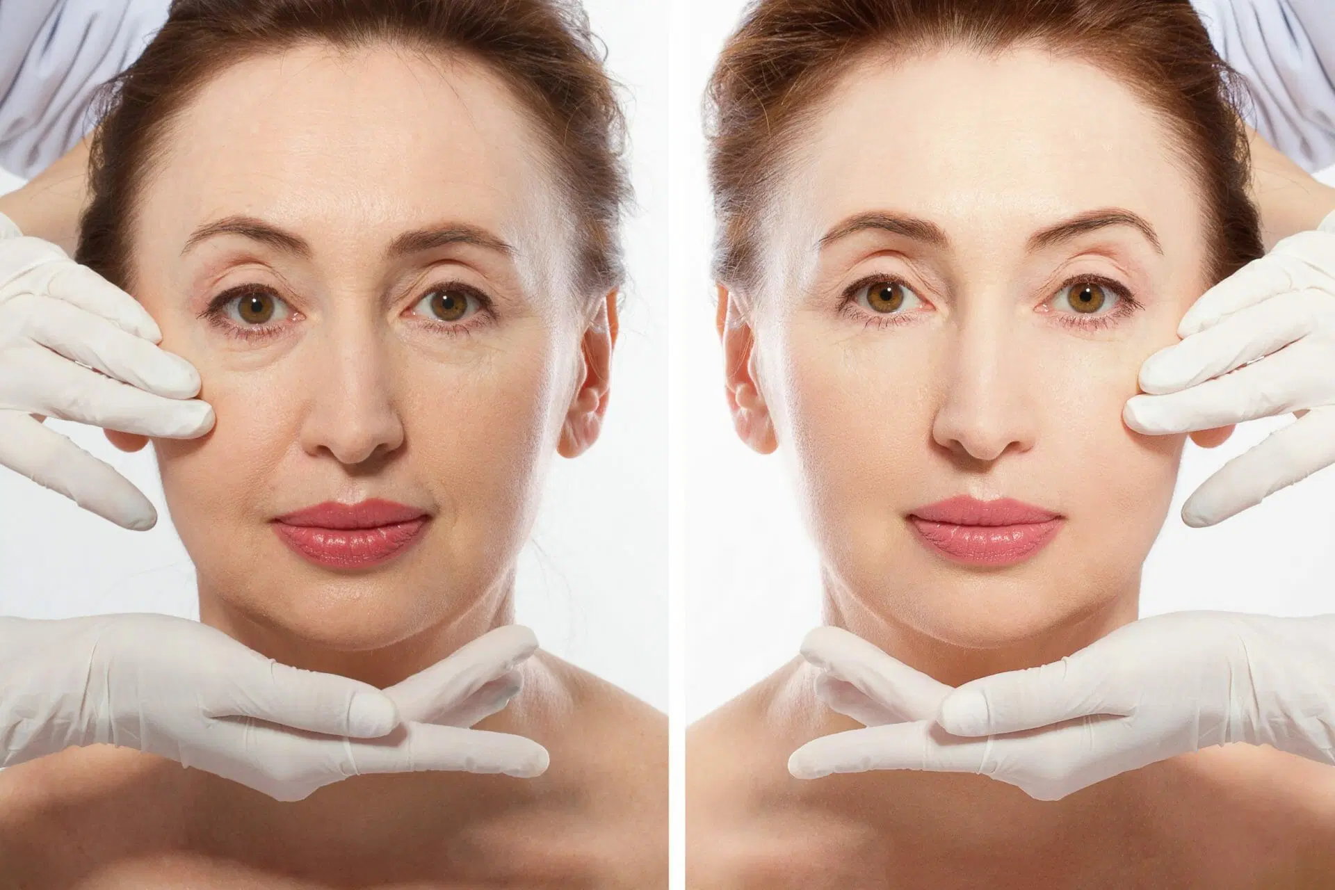 Debunking the Common Mini Face Lift That Most People Have Believed In