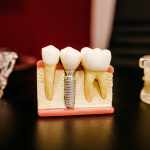5 Warning Signs You Need a Root Canal Immediately
