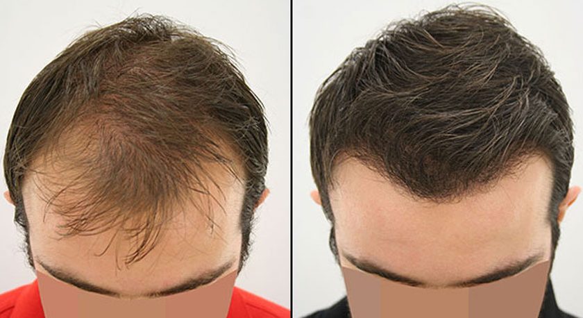 What to Expect from 6000 Grafts Hair Transplant Surgery in Turkey