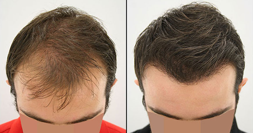 What to Expect from 6000 Grafts Hair Transplant Surgery in Turkey