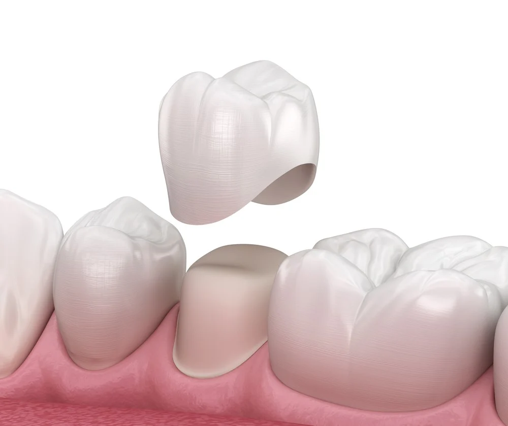 ﻿Thinking About Getting Porcelain Crowns? Here is What You Should Know