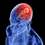 Five Facts about Brain Cancer Everyone Need To Understand