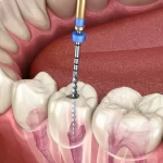 Preparation for the Root Canal Procedure: What You Need to Know