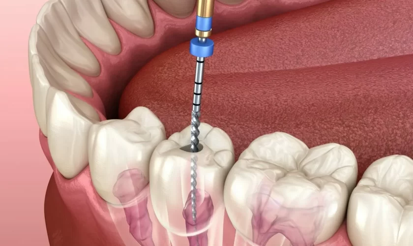 Preparation for the Root Canal Procedure: What You Need to Know