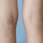 Can_Spider_Veins_Return_After_Treatment_638131611398899179
