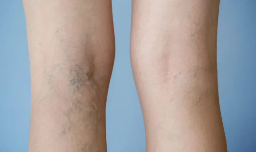 Avoid The Appearance Of Spider Veins – Follow These Tips