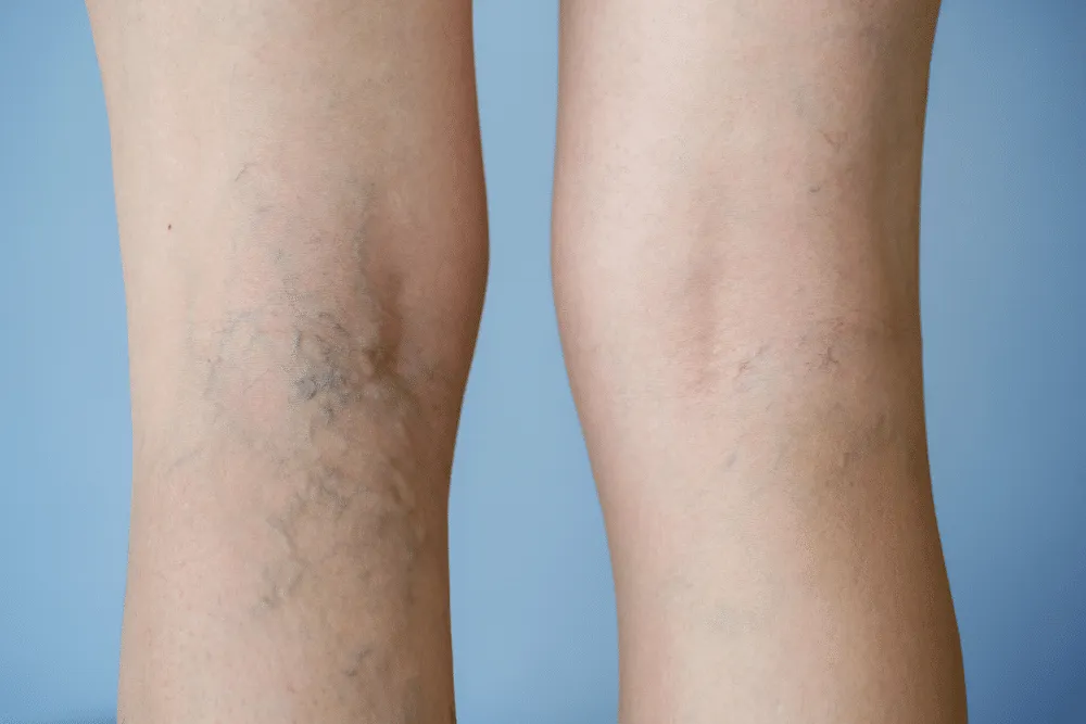 Avoid The Appearance Of Spider Veins – Follow These Tips