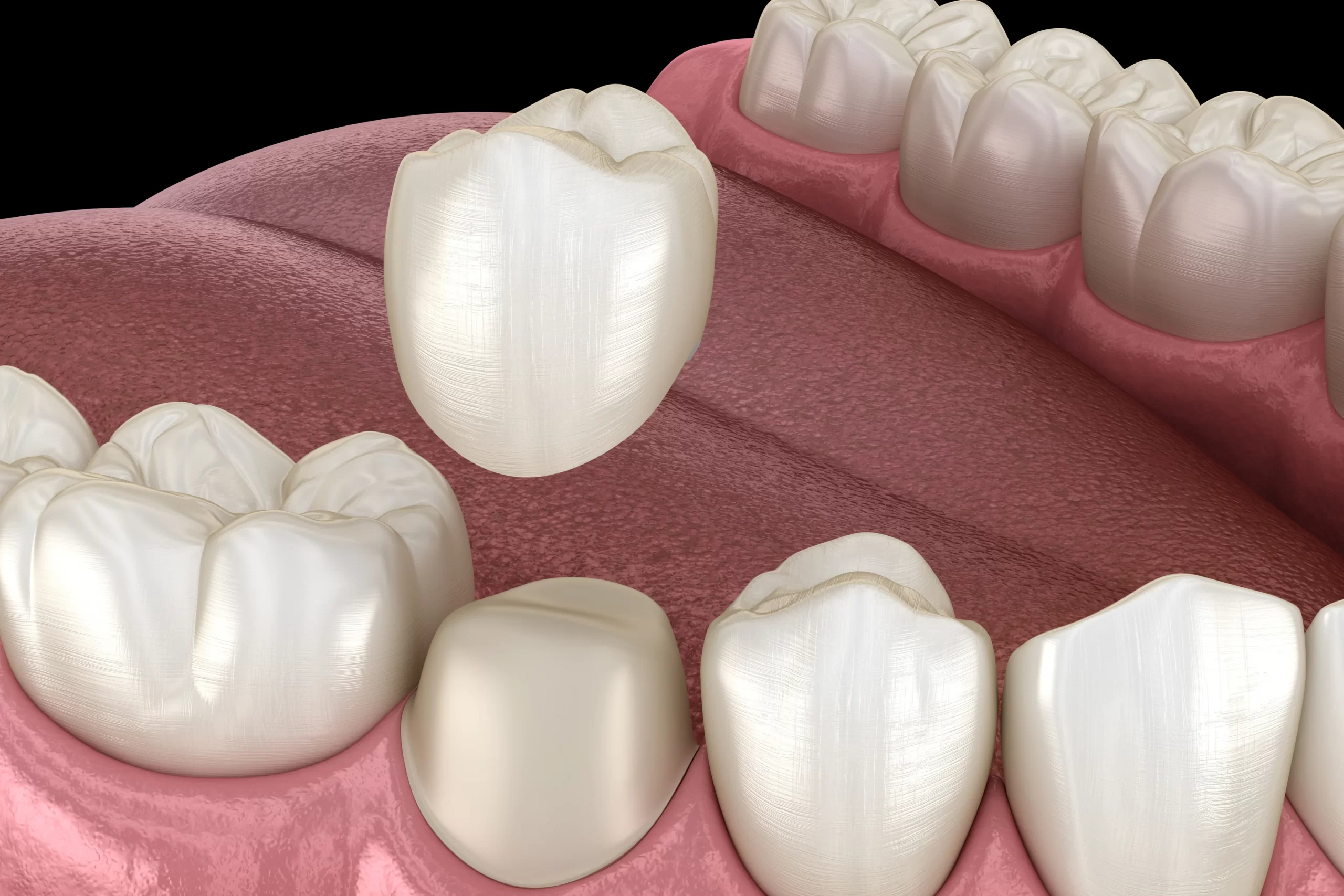 The Dental Crown Broke: What to Do?