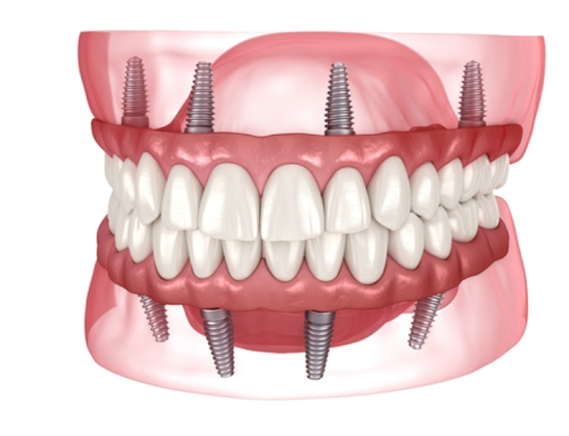 Full Mouth Dental Implants in Hungary